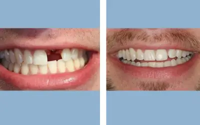 Before and After